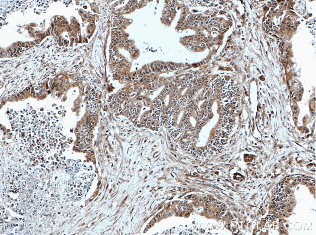 Immunohistochemistry (IHC) staining of human pancreas cancer tissue using MEST Polyclonal antibody (11118-1-AP)