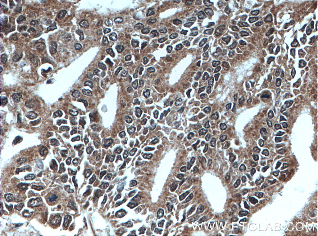 Immunohistochemistry (IHC) staining of human pancreas cancer tissue using MEST Polyclonal antibody (11118-1-AP)