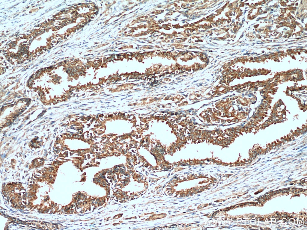 Immunohistochemistry (IHC) staining of human prostate cancer tissue using MEST Monoclonal antibody (60263-1-Ig)