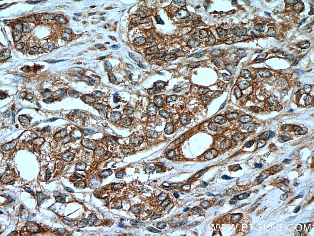 Immunohistochemistry (IHC) staining of human prostate cancer tissue using MEST Monoclonal antibody (60263-1-Ig)
