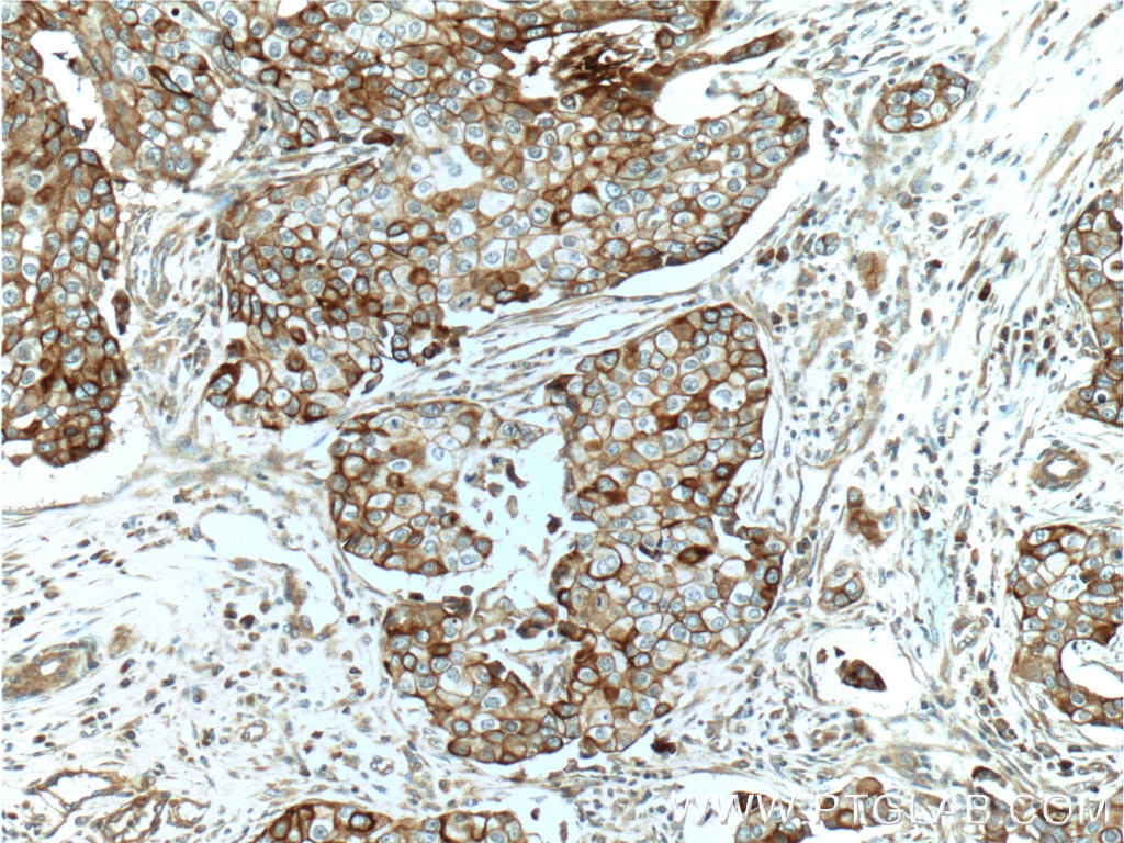 Immunohistochemistry (IHC) staining of human breast cancer tissue using c-Met (N-terminal) Polyclonal antibody (19971-1-AP)