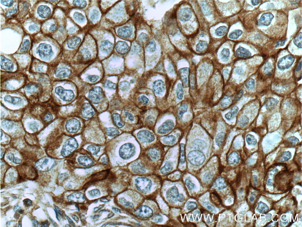 Immunohistochemistry (IHC) staining of human breast cancer tissue using c-Met (N-terminal) Polyclonal antibody (19971-1-AP)