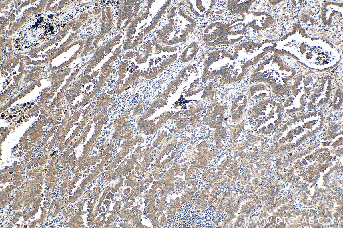Immunohistochemistry (IHC) staining of human lung cancer tissue using c-Met (Cytoplasmic) Polyclonal antibody (25869-1-AP)