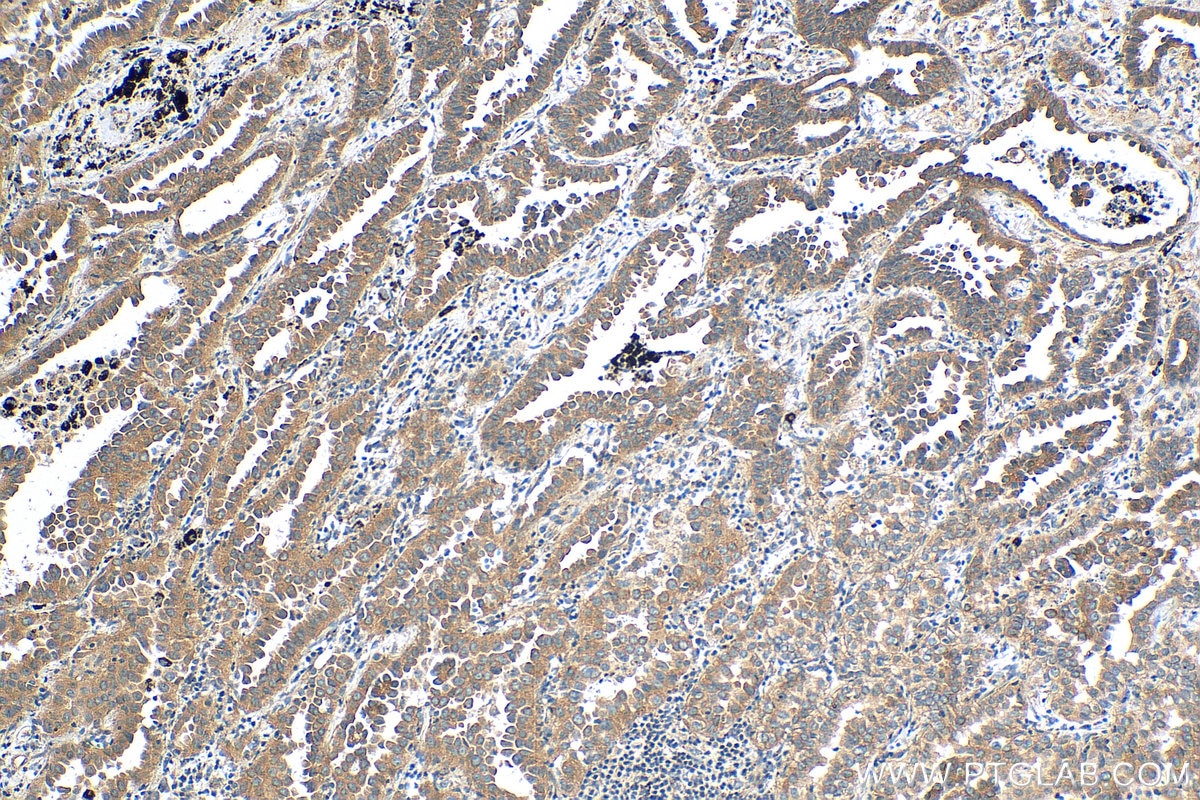 IHC staining of human lung cancer using 25869-1-AP