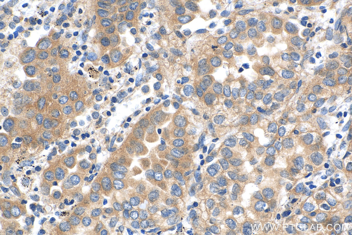 IHC staining of human lung cancer using 25869-1-AP