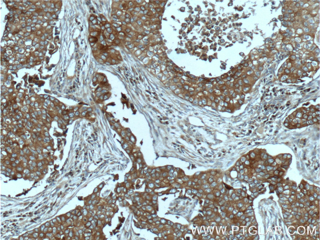 Immunohistochemistry (IHC) staining of human breast cancer tissue using c-Met (Cytoplasmic) Polyclonal antibody (25869-1-AP)