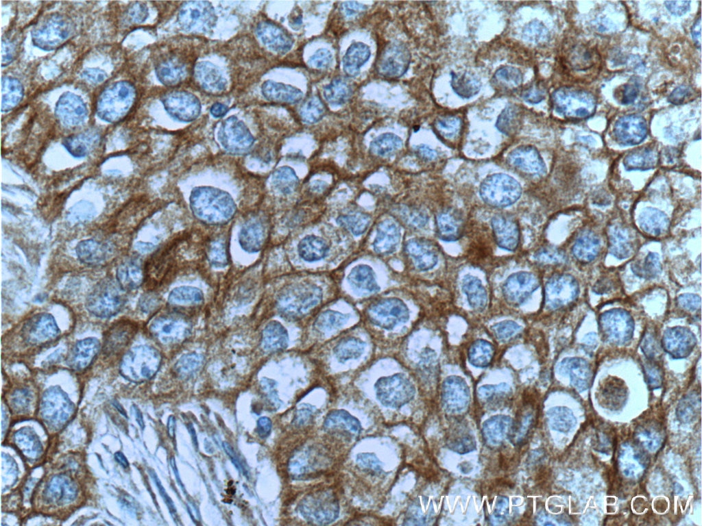 Immunohistochemistry (IHC) staining of human breast cancer tissue using c-Met (Cytoplasmic) Polyclonal antibody (25869-1-AP)