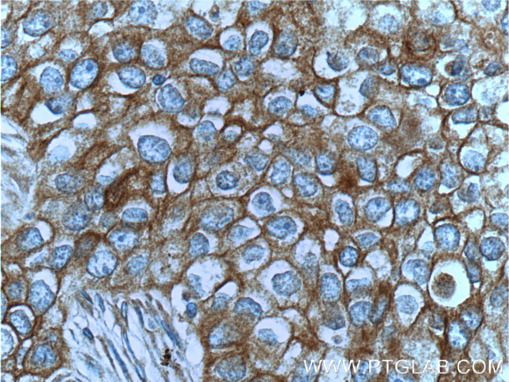 IHC staining of human breast cancer using 25869-1-AP