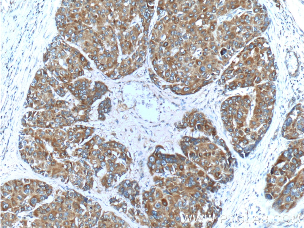 Immunohistochemistry (IHC) staining of human liver cancer tissue using c-Met (Cytoplasmic) Polyclonal antibody (25869-1-AP)