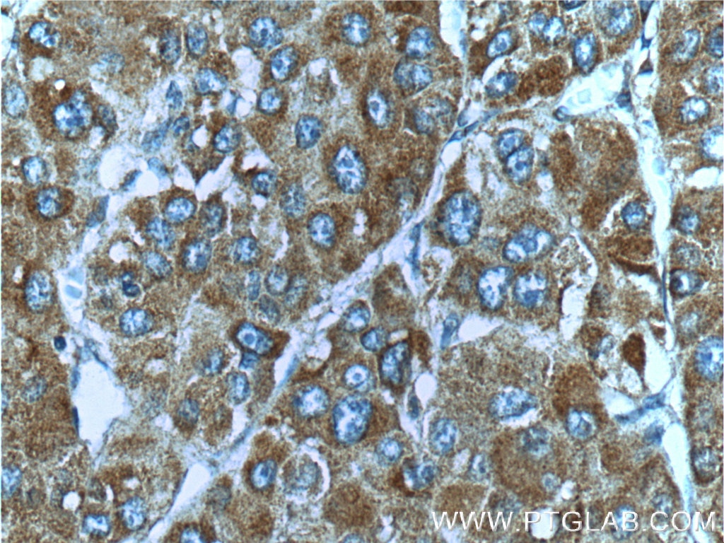 Immunohistochemistry (IHC) staining of human liver cancer tissue using c-Met (Cytoplasmic) Polyclonal antibody (25869-1-AP)