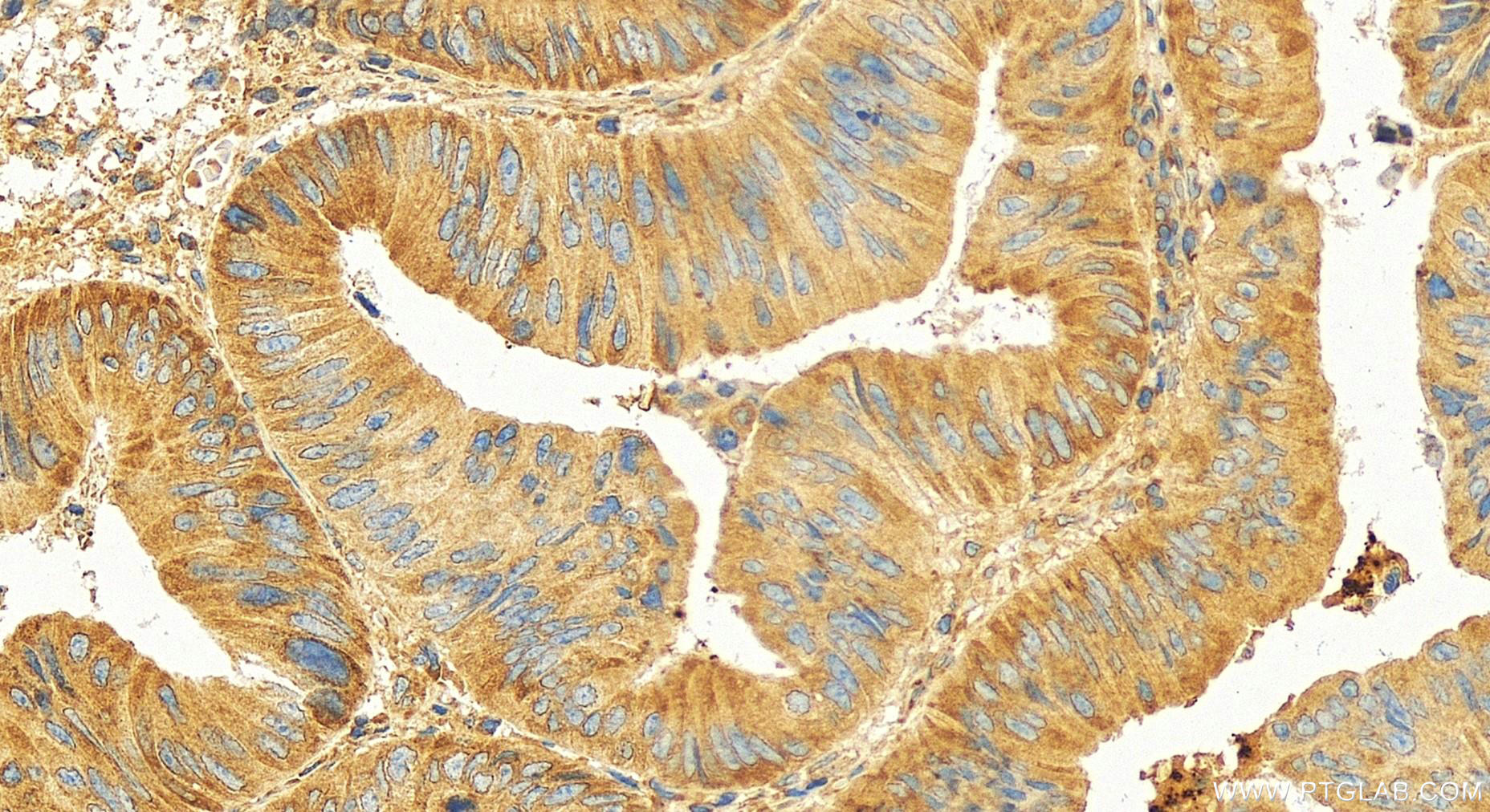 Immunohistochemical analysis of paraffin-embedded human colon cancer slide using 17040-1-AP (METAP2 antibody) at dilution of 1:100 (under 20x lens). Heat mediated antigen retrieval with Tris-EDTA buffer (pH 9.0). Immunohistochemistry (IHC) staining of human colon cancer using METAP2 Polyclonal antibody (17040-1-AP)