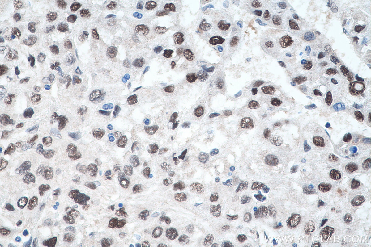 Immunohistochemistry (IHC) staining of human liver cancer tissue using METTL1 Polyclonal antibody (14994-1-AP)