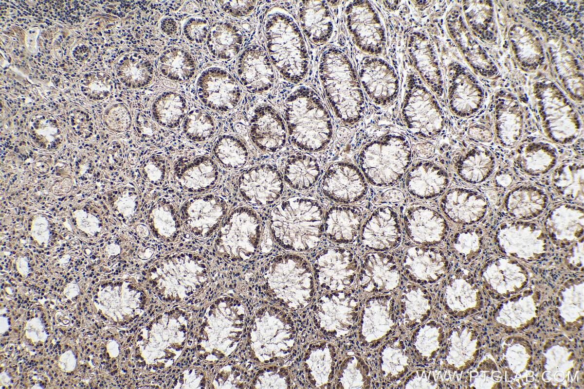 Immunohistochemistry (IHC) staining of human colon cancer tissue using METTL14 Recombinant antibody (80790-1-RR)