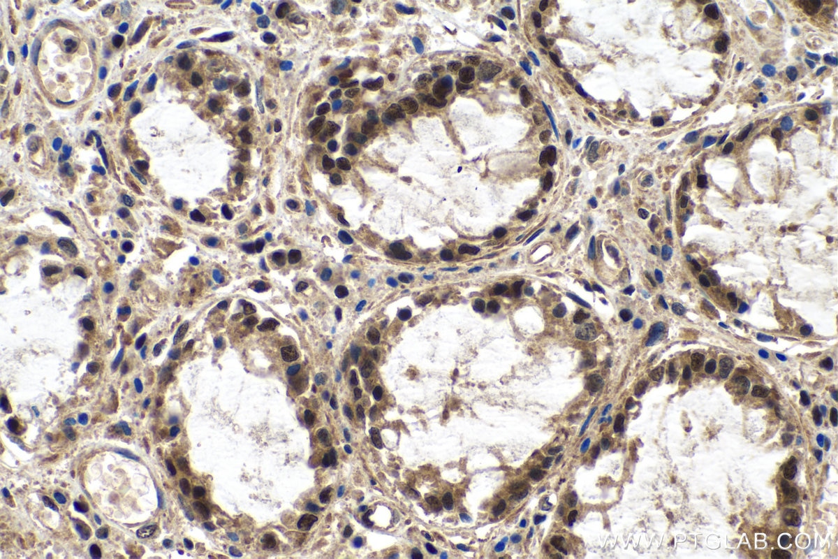 Immunohistochemistry (IHC) staining of human colon cancer tissue using METTL14 Recombinant antibody (80790-1-RR)