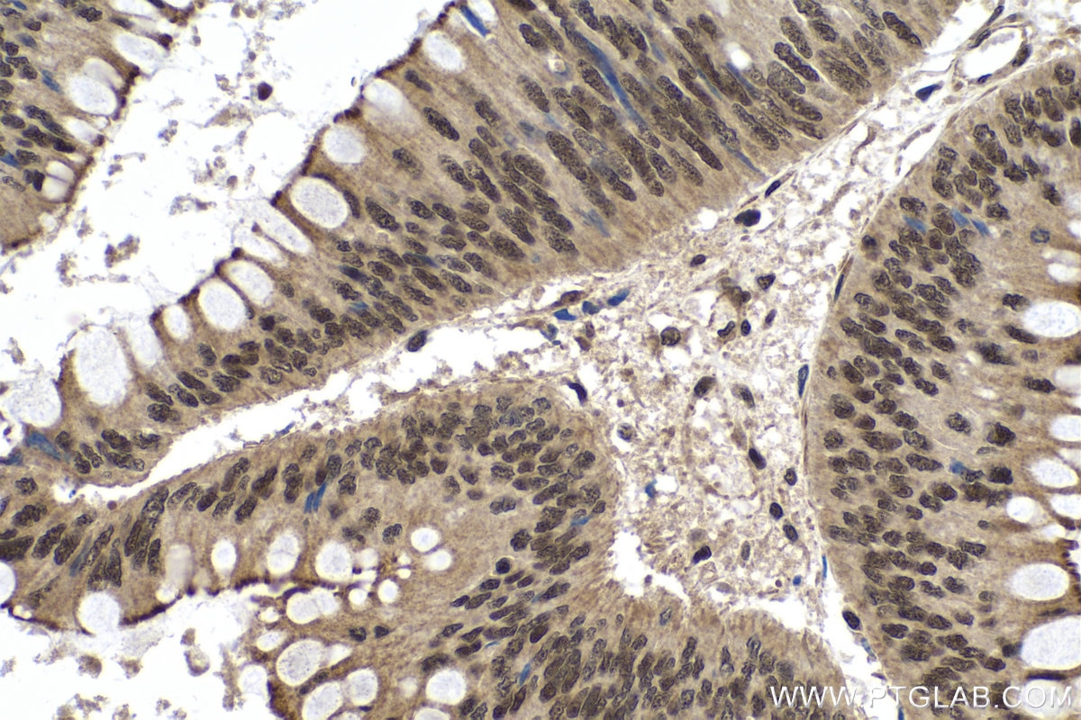 Immunohistochemistry (IHC) staining of human colon cancer tissue using METTL14 Recombinant antibody (80790-1-RR)