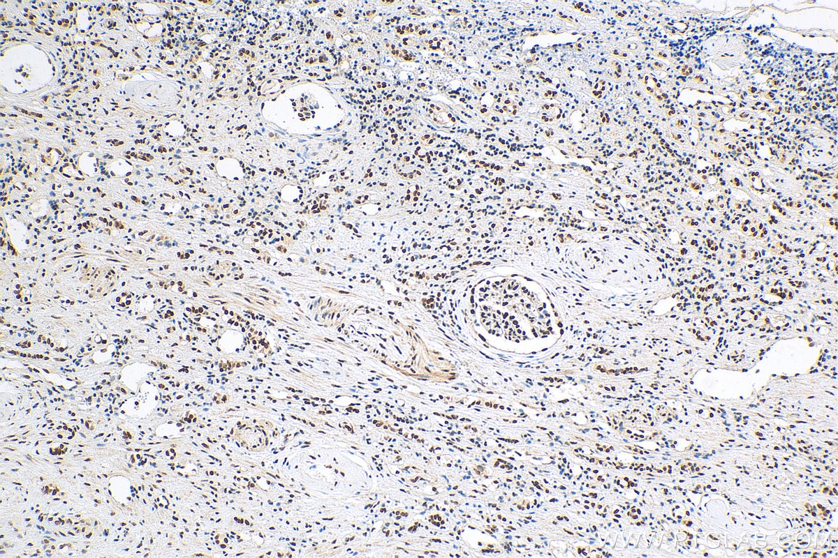 Immunohistochemistry (IHC) staining of human renal cell carcinoma tissue using METTL3 Polyclonal antibody (15073-1-AP)