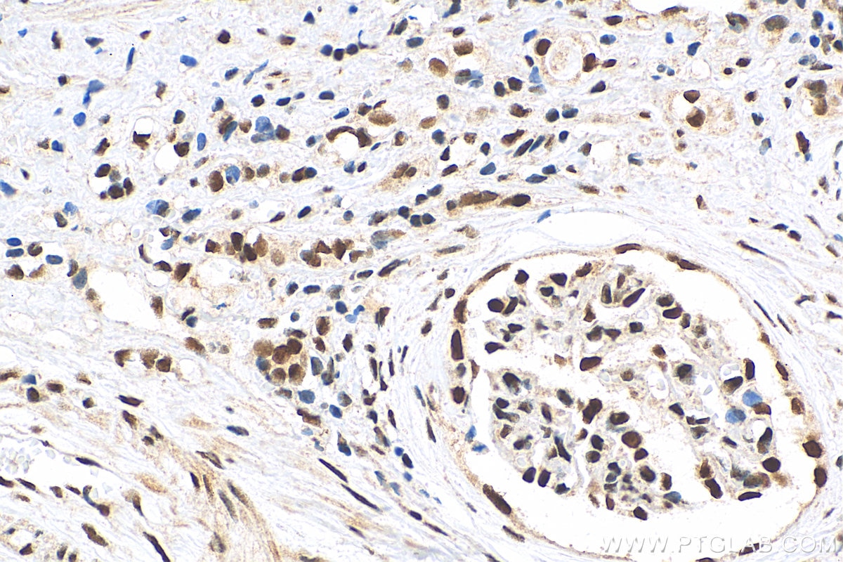 Immunohistochemistry (IHC) staining of human renal cell carcinoma tissue using METTL3 Polyclonal antibody (15073-1-AP)