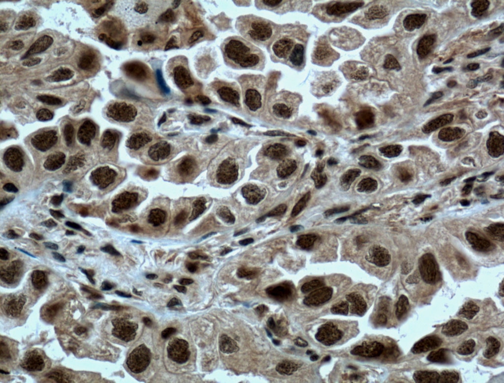 Immunohistochemistry (IHC) staining of human lung cancer tissue using METTL3 Polyclonal antibody (15073-1-AP)