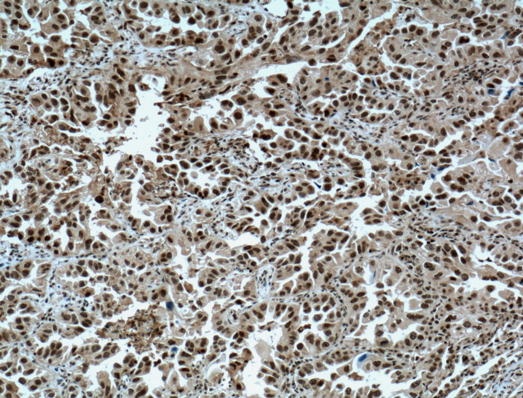 Immunohistochemistry (IHC) staining of human lung cancer tissue using METTL3 Polyclonal antibody (15073-1-AP)