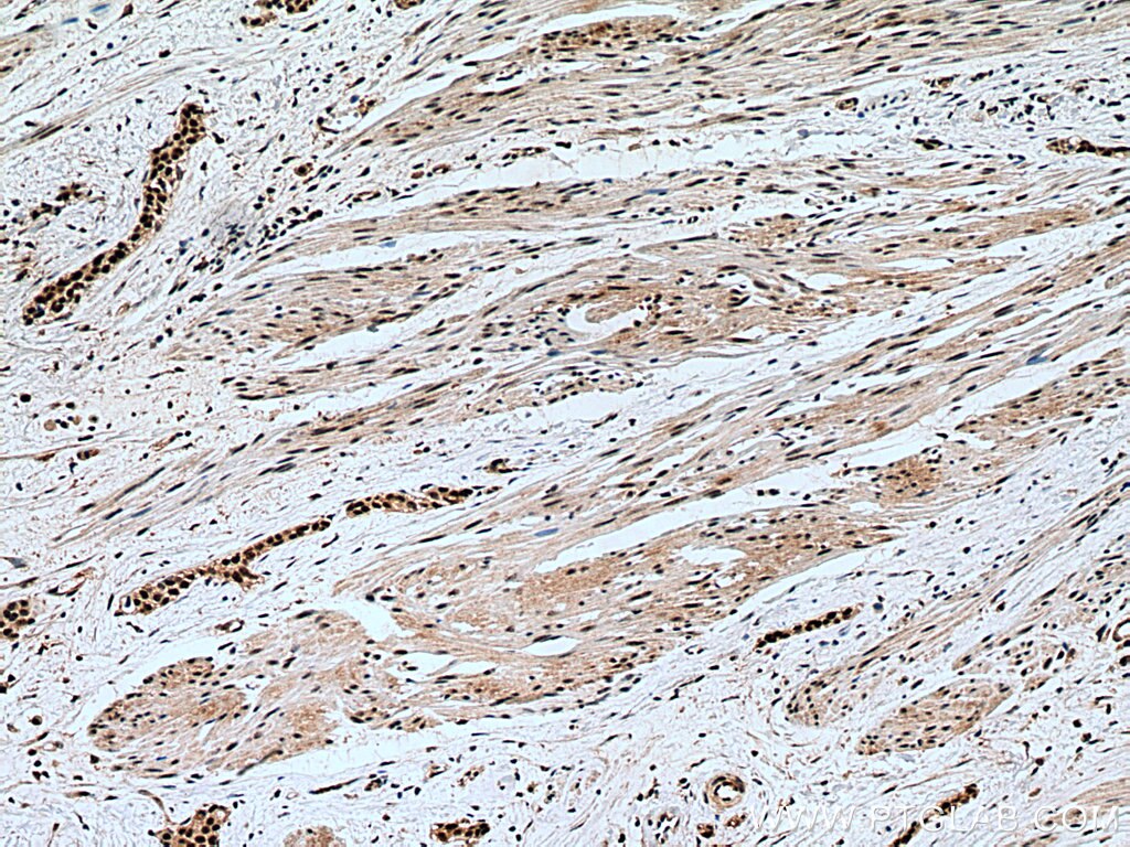 Immunohistochemistry (IHC) staining of human urothelial carcinoma tissue using METTL3 Monoclonal antibody (67733-1-Ig)