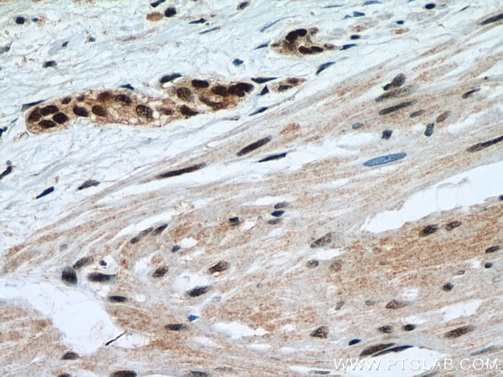 Immunohistochemistry (IHC) staining of human urothelial carcinoma tissue using METTL3 Monoclonal antibody (67733-1-Ig)