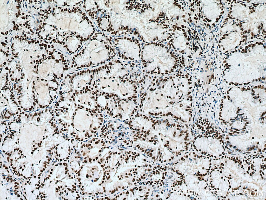 Immunohistochemistry (IHC) staining of human lung cancer tissue using METTL3 Monoclonal antibody (67733-1-Ig)