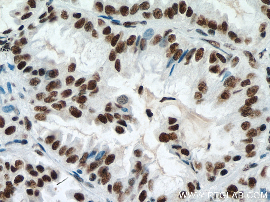 Immunohistochemistry (IHC) staining of human lung cancer tissue using METTL3 Monoclonal antibody (67733-1-Ig)