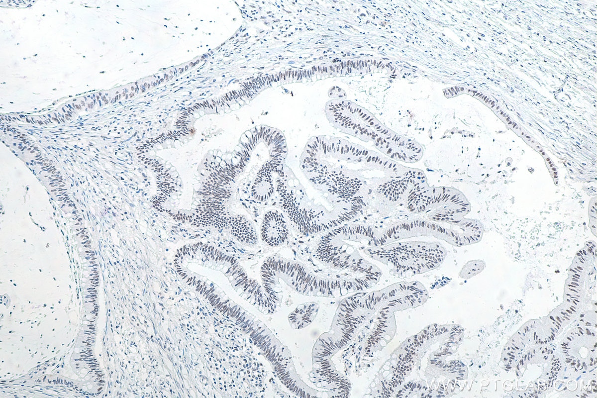 Immunohistochemistry (IHC) staining of human colon cancer tissue using METTL3 Monoclonal antibody (67733-1-Ig)