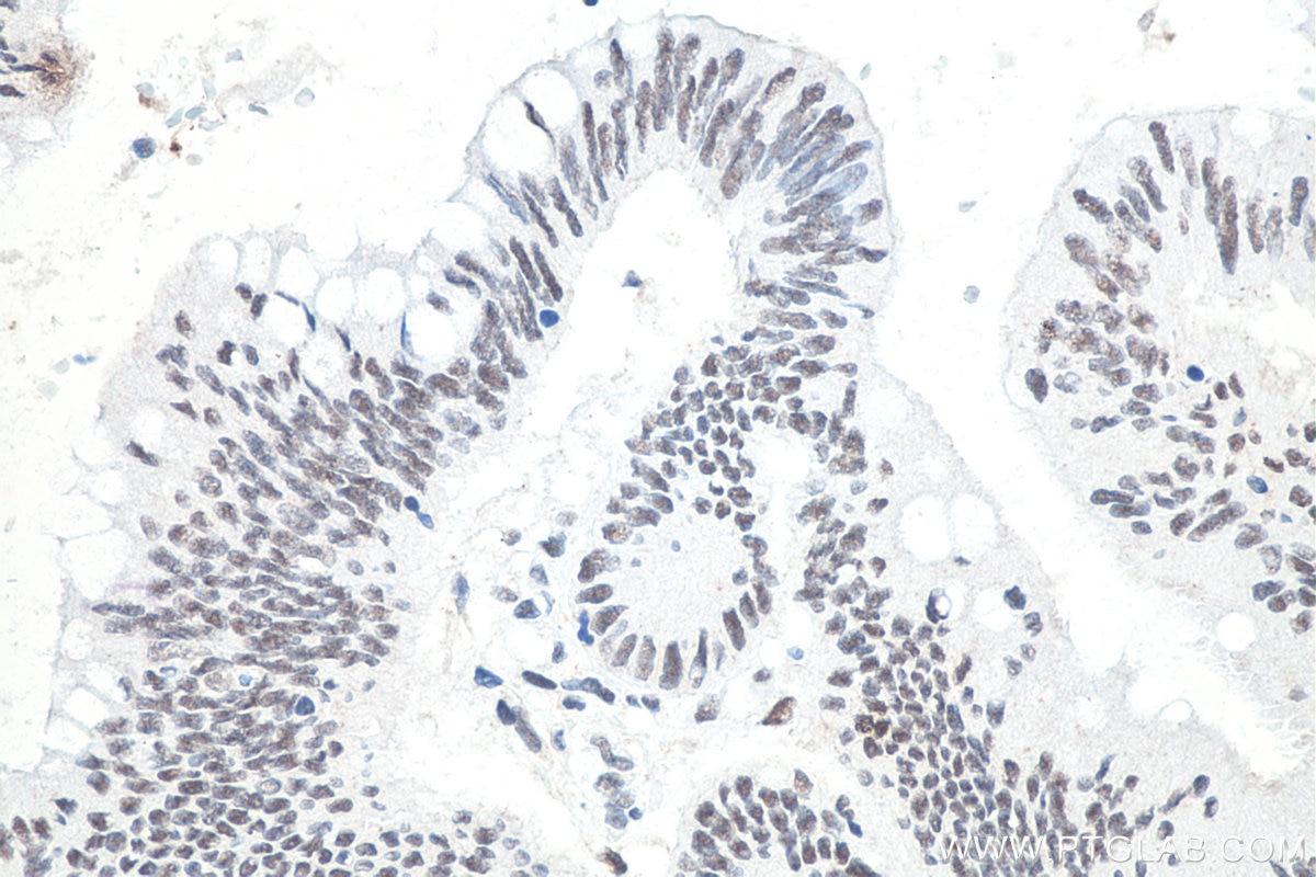 Immunohistochemistry (IHC) staining of human colon cancer tissue using METTL3 Monoclonal antibody (67733-1-Ig)
