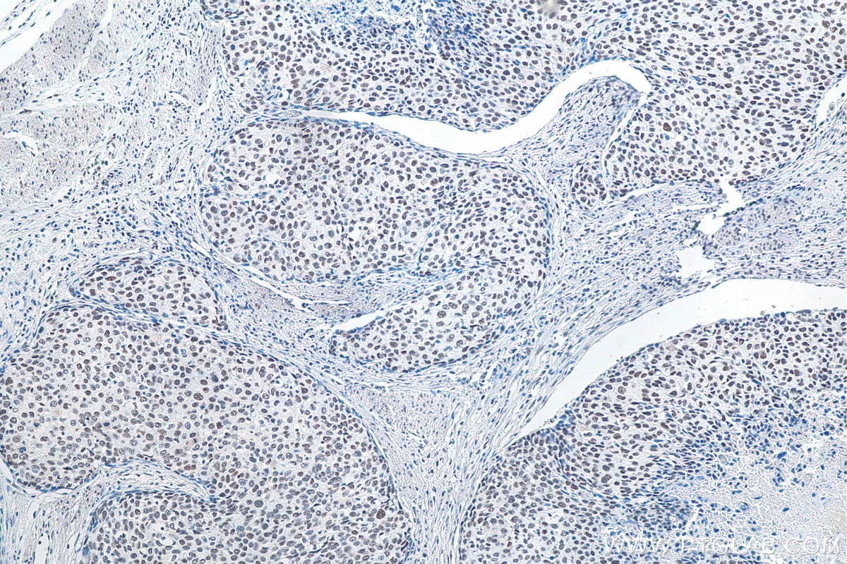 Immunohistochemistry (IHC) staining of human oesophagus cancer tissue using METTL3 Monoclonal antibody (67733-1-Ig)