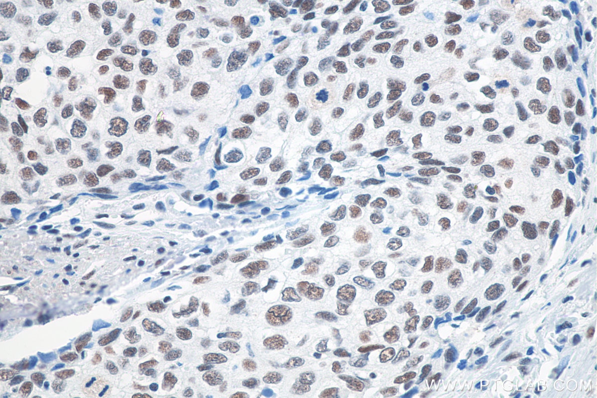 Immunohistochemistry (IHC) staining of human oesophagus cancer tissue using METTL3 Monoclonal antibody (67733-1-Ig)