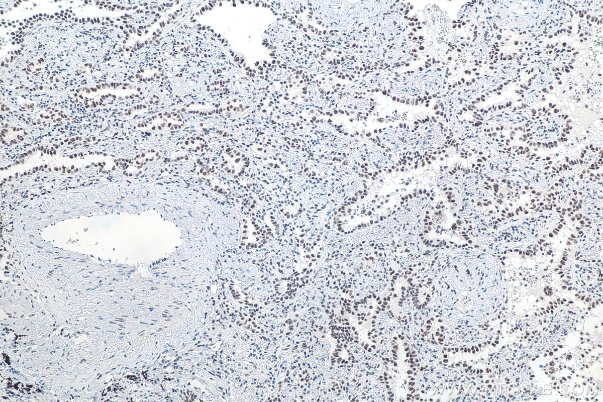 Immunohistochemistry (IHC) staining of human lung cancer tissue using METTL3 Monoclonal antibody (67733-1-Ig)