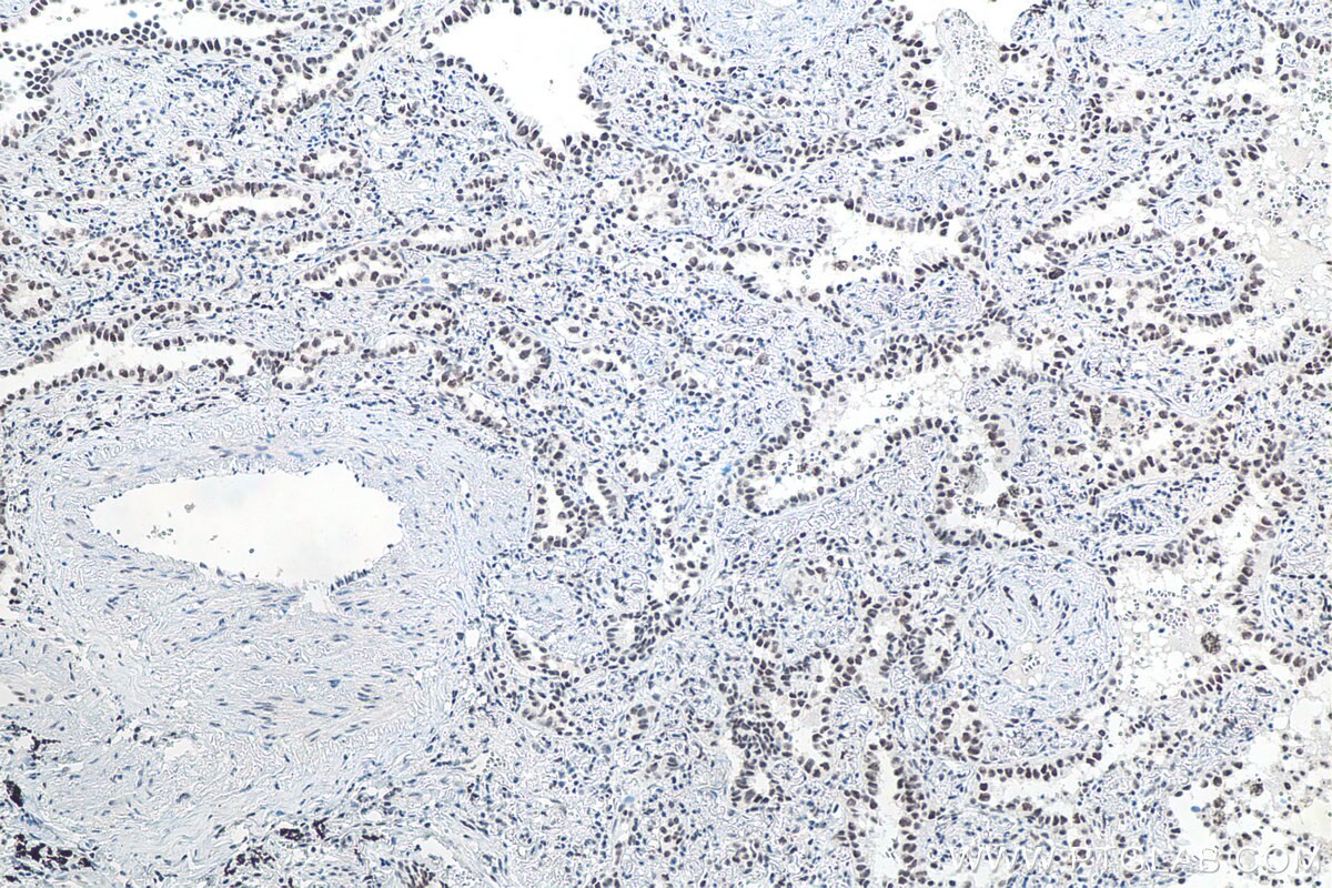 Immunohistochemistry (IHC) staining of human lung cancer tissue using METTL3 Monoclonal antibody (67733-1-Ig)