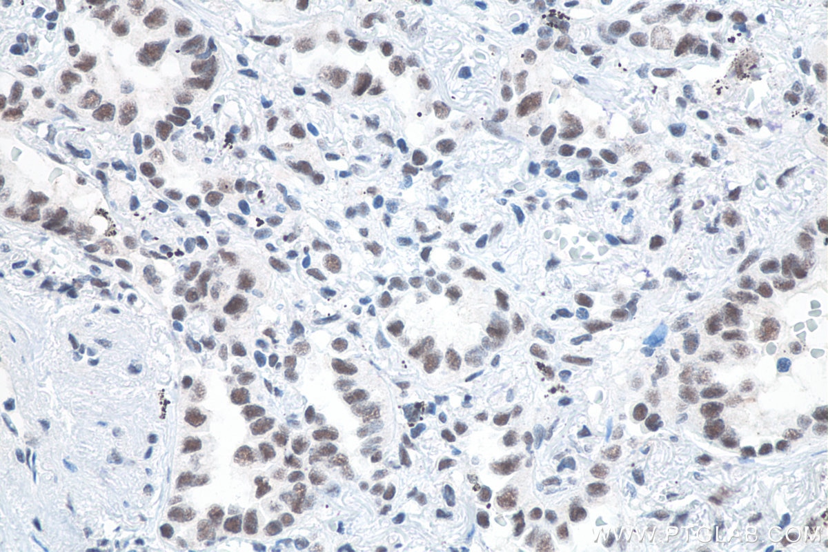 Immunohistochemistry (IHC) staining of human lung cancer tissue using METTL3 Monoclonal antibody (67733-1-Ig)