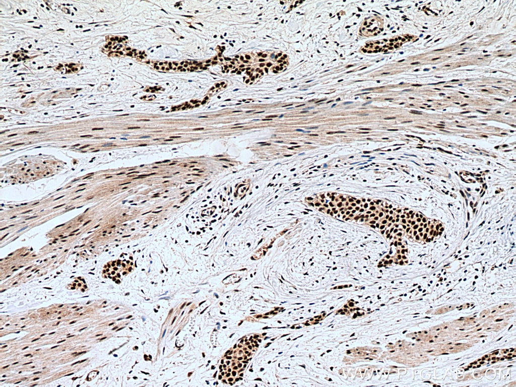 Immunohistochemistry (IHC) staining of human urothelial carcinoma tissue using METTL3 Monoclonal antibody (67733-2-Ig)