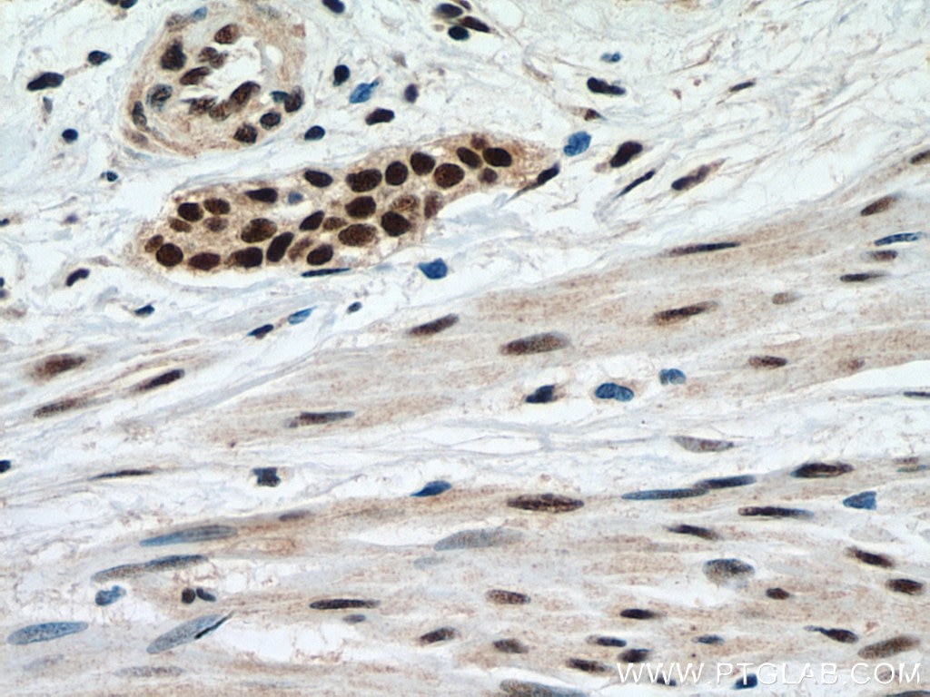 Immunohistochemistry (IHC) staining of human urothelial carcinoma tissue using METTL3 Monoclonal antibody (67733-2-Ig)