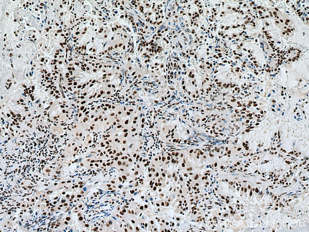 Immunohistochemistry (IHC) staining of human lung cancer tissue using METTL3 Monoclonal antibody (67733-2-Ig)