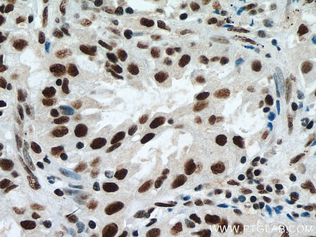 Immunohistochemistry (IHC) staining of human lung cancer tissue using METTL3 Monoclonal antibody (67733-2-Ig)
