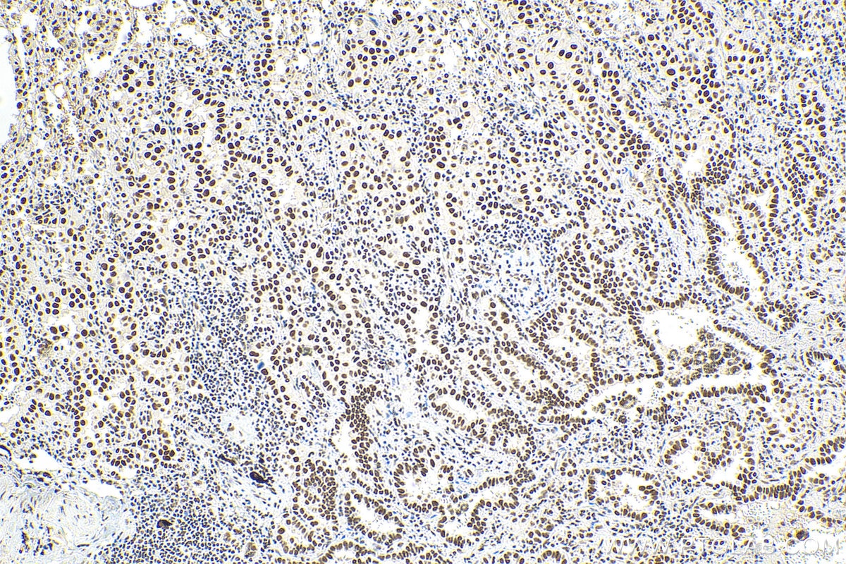 Immunohistochemistry (IHC) staining of human lung cancer tissue using METTL3 Recombinant antibody (80323-1-RR)