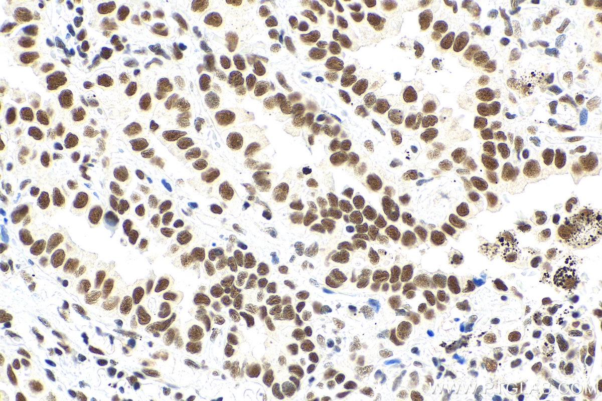 Immunohistochemistry (IHC) staining of human lung cancer tissue using METTL3 Recombinant antibody (80323-1-RR)