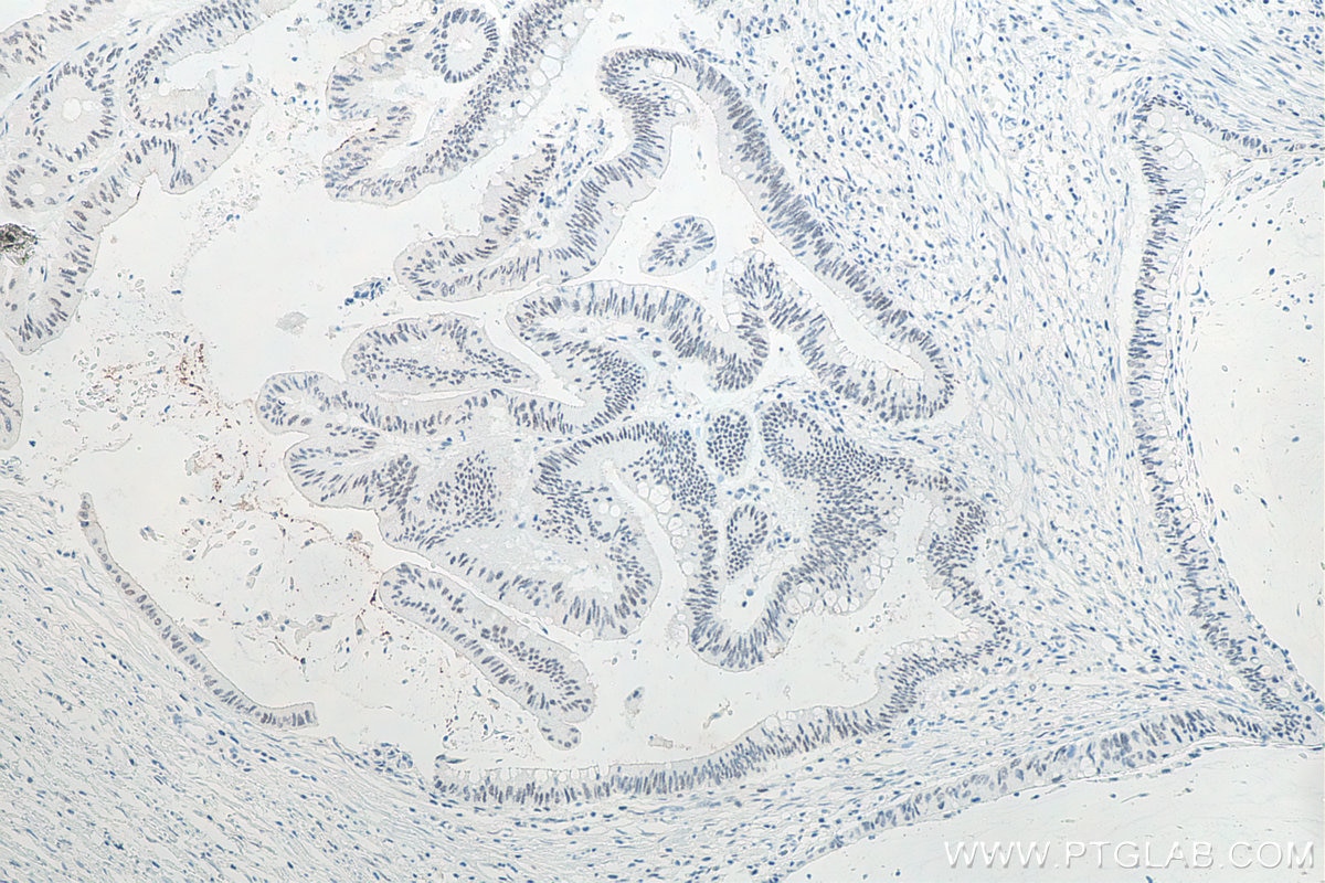 Immunohistochemistry (IHC) staining of human colon cancer tissue using METTL3 Recombinant antibody (80323-1-RR)