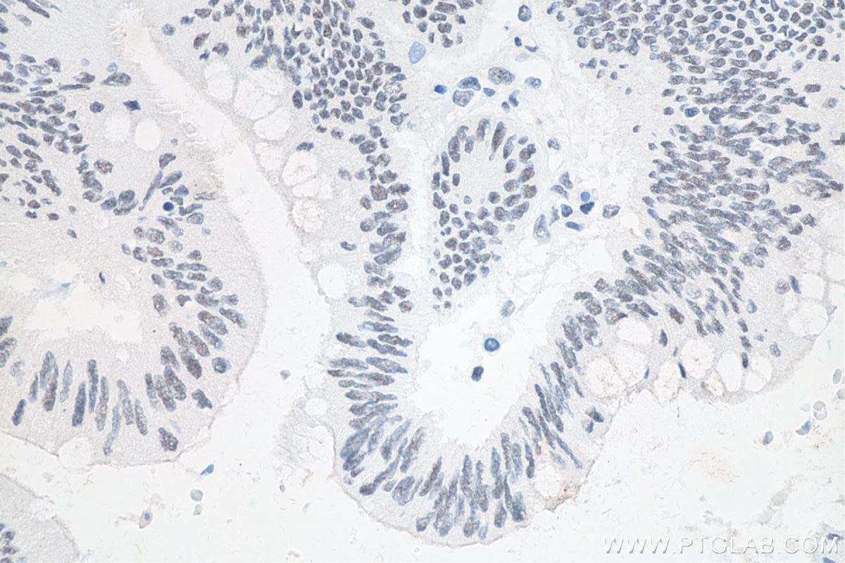 Immunohistochemistry (IHC) staining of human colon cancer tissue using METTL3 Recombinant antibody (80323-1-RR)