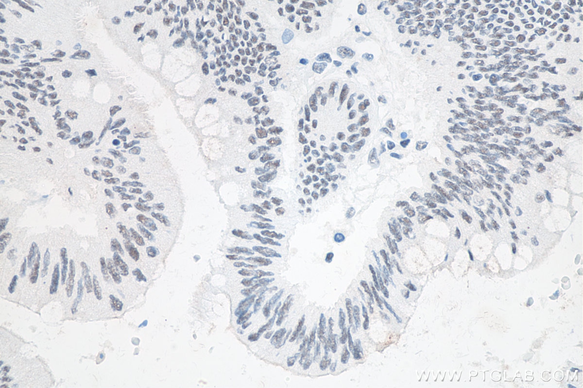 IHC staining of human colon cancer using 80323-1-RR