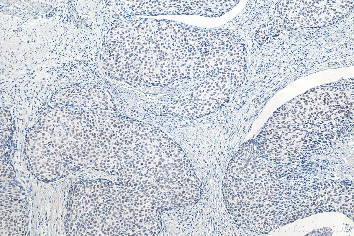 IHC staining of human oesophagus cancer using 80323-1-RR