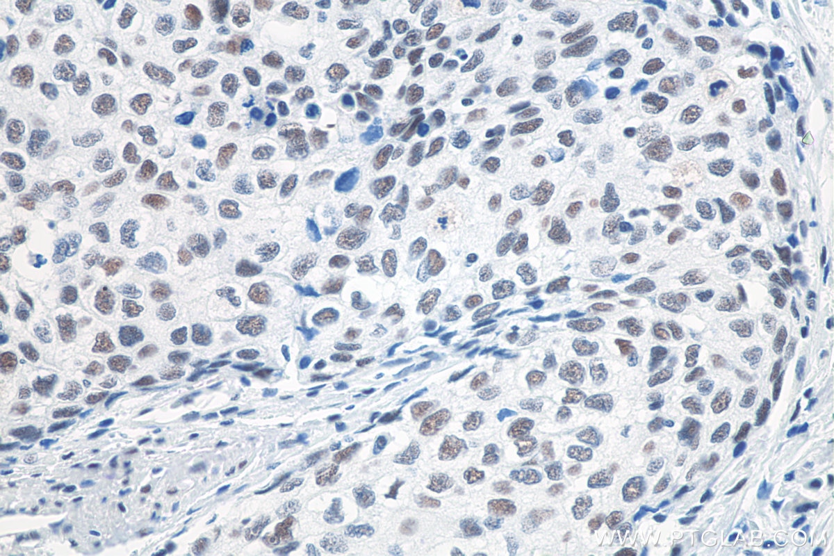 Immunohistochemistry (IHC) staining of human oesophagus cancer tissue using METTL3 Recombinant antibody (80323-1-RR)