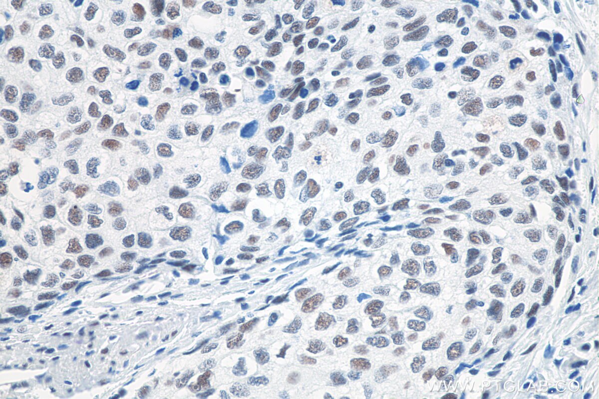 IHC staining of human oesophagus cancer using 80323-1-RR