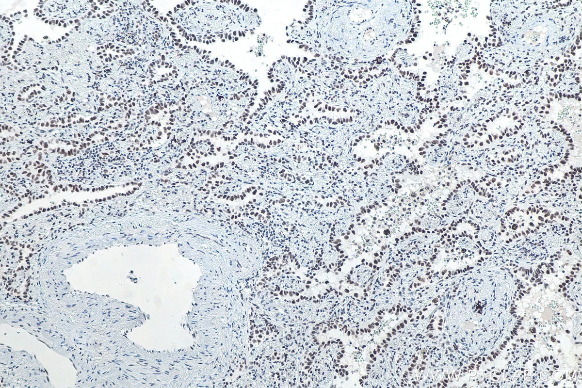 Immunohistochemistry (IHC) staining of human lung cancer tissue using METTL3 Recombinant antibody (80323-1-RR)