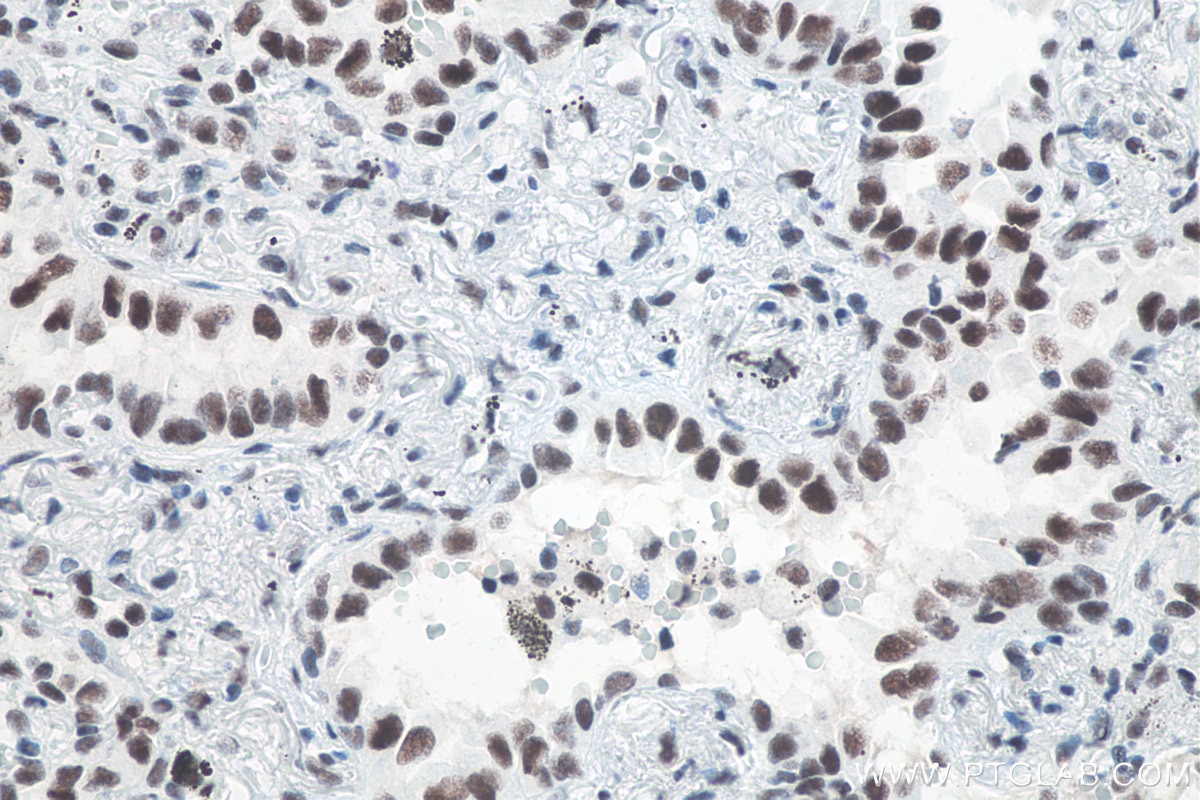 Immunohistochemistry (IHC) staining of human lung cancer tissue using METTL3 Recombinant antibody (80323-1-RR)