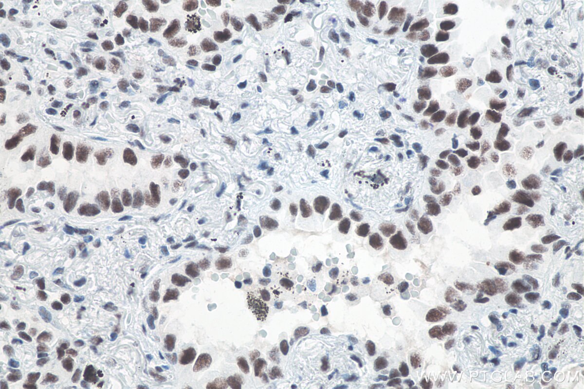 IHC staining of human lung cancer using 80323-1-RR