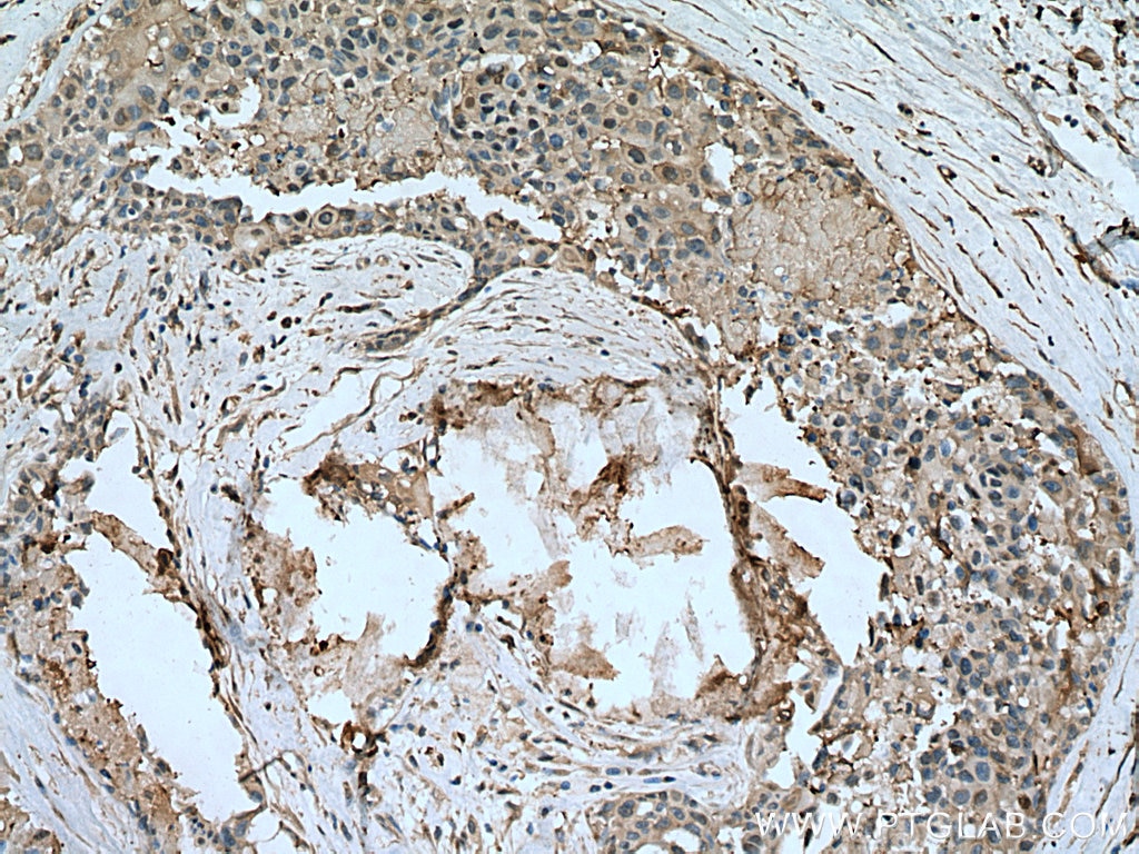 Immunohistochemistry (IHC) staining of human breast cancer tissue using METTL6 Polyclonal antibody (16527-1-AP)